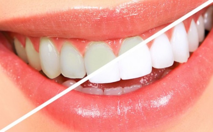 غالبا ما يشكل جمال الابتسامة هاجسا يلاحق الأشخاص، ويعتبر تبيض الأسنان من أكثر العمليات التجميلية، ولكن أسهل طريقة للحفاظ على بياض الأسنان هو تنظيفها بشكل دائم.

وقام طبيب الأسنان طارق إدريس، 
