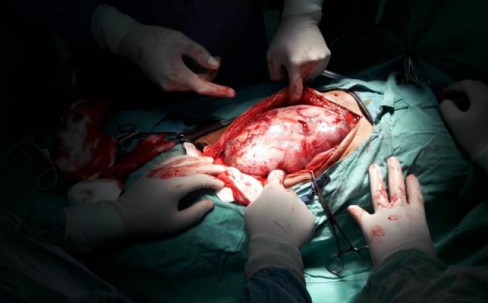تمكن أطباء من قسم الجراحة العامة في مستشفى غزة الأوروبي في مدينة خانيونس، من استئصال ورم يزن 7 كجم، من مريض "الكانسر" السرطان.

وأكد رئيس أقسام الجراحة الاستشاري عماد الحوت أنه وبعدما قام ا